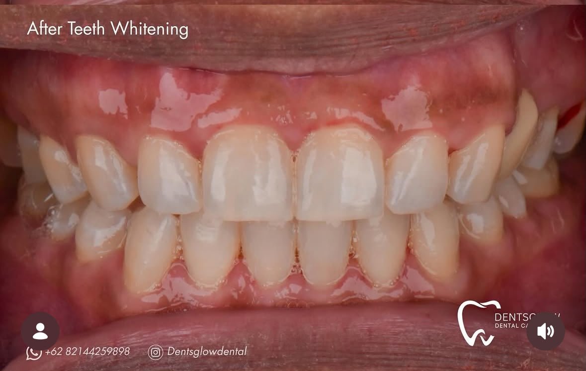Whitening After