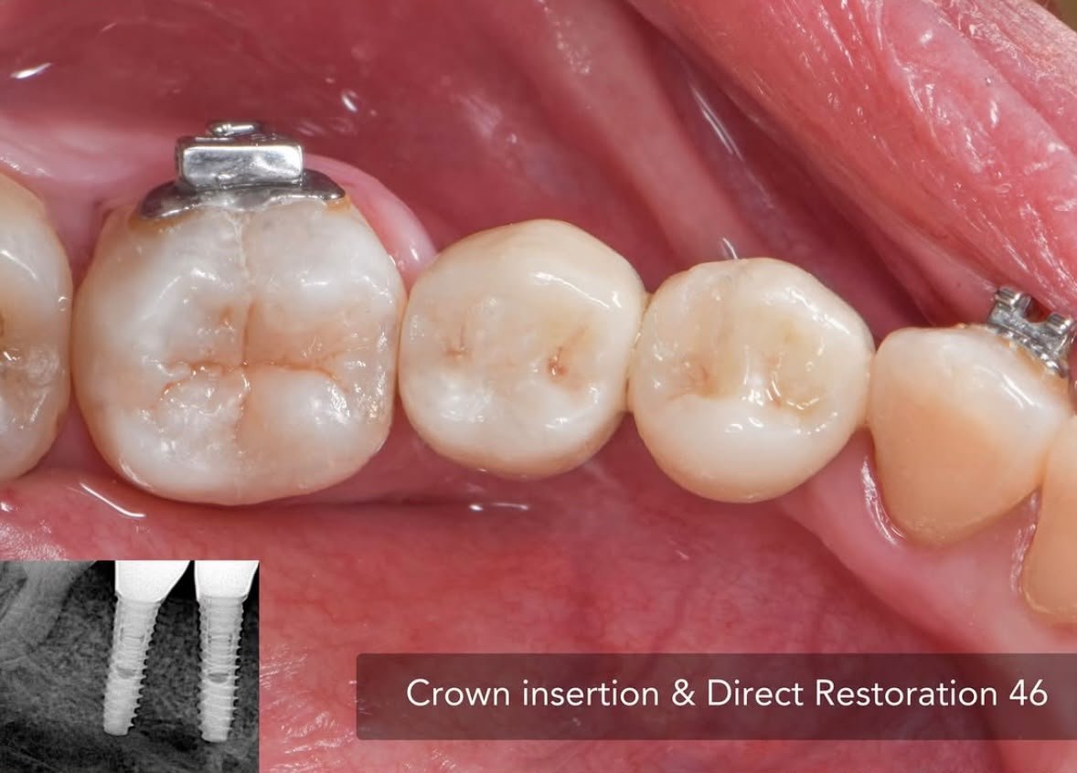 Implant After